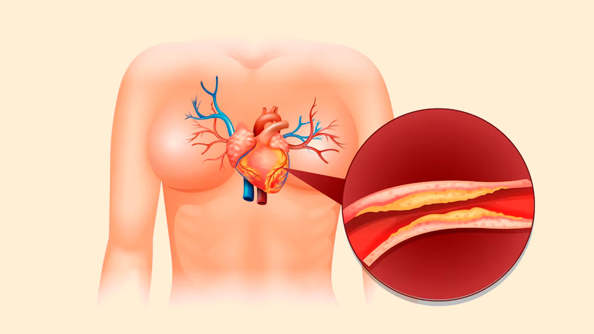 Did You Know You Can Unclog Your Arteries? Expert Shares How!