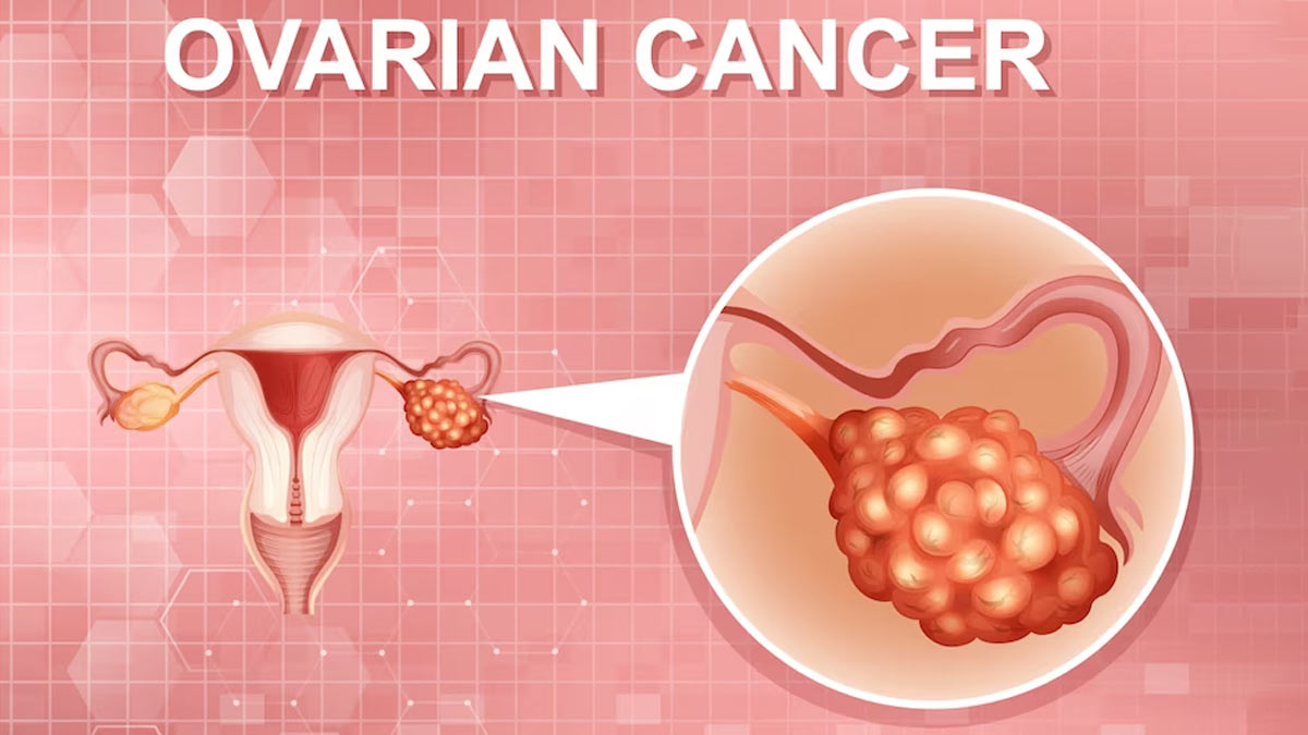 Early Undetected Signs Of Ovarian Cancer You Need To Be Aware Of, Expert Sheds Light