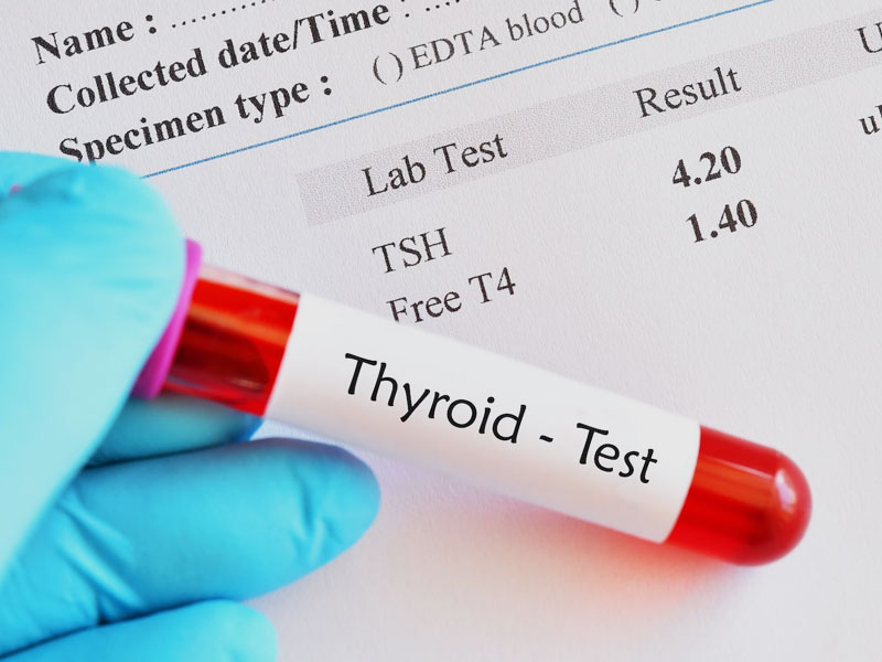 What Is Thyroid Stimulating Hormone Test? Here' When You Need One!