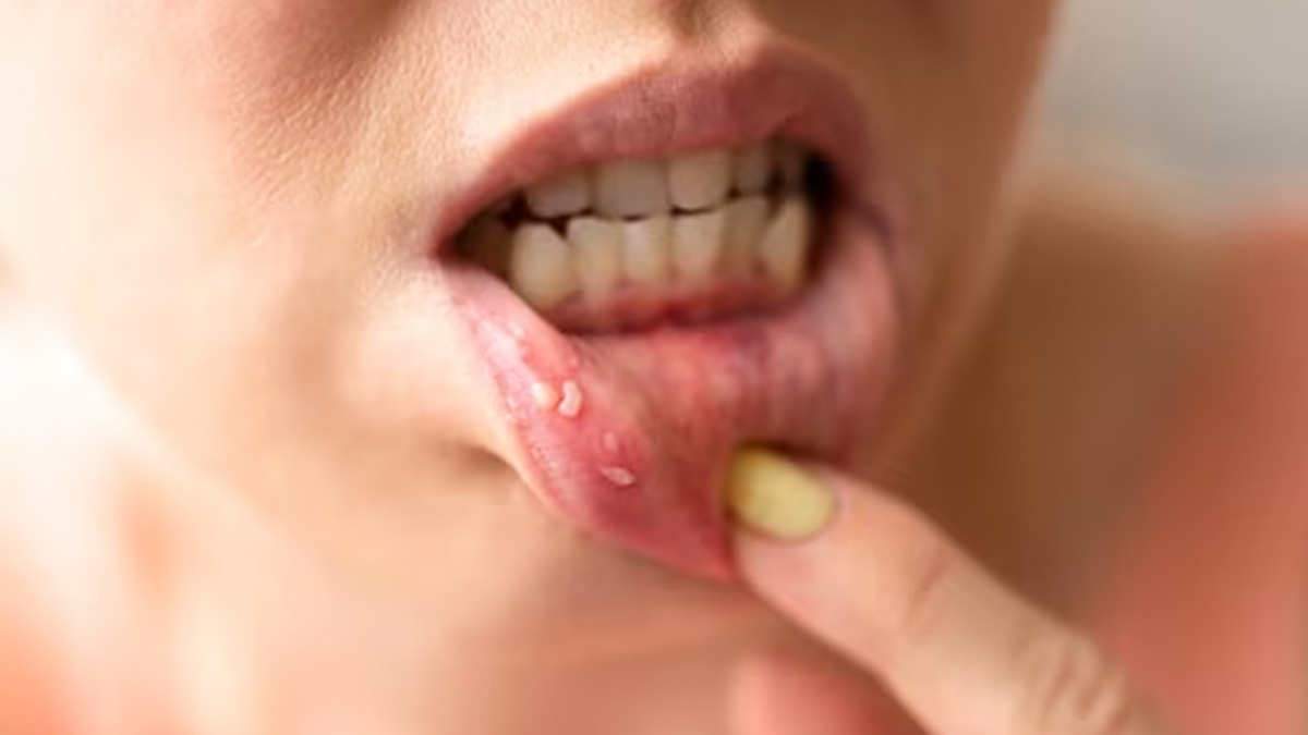 Oral Cancer Doesn't Always Happen Due To Smoking, Expert Warns! Here Are Other Causes