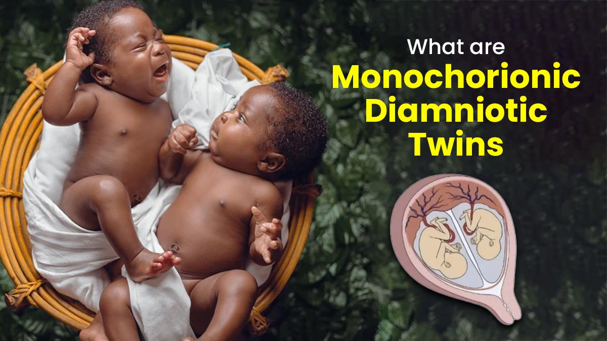 What are Monochorionic-Diamniotic Twins (MCDA)? Is Normal Delivery Possible in Such a Case?