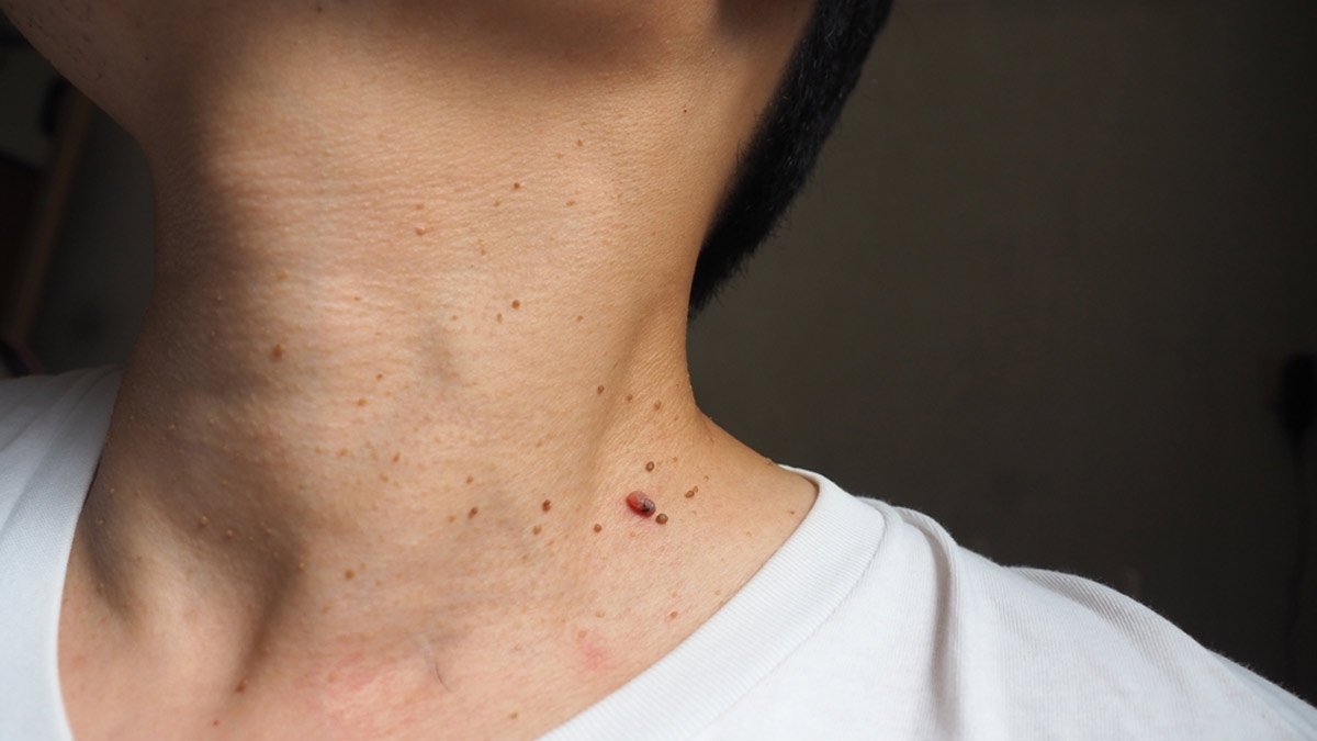 Why Some People With Diabetes Develop Skin Tags