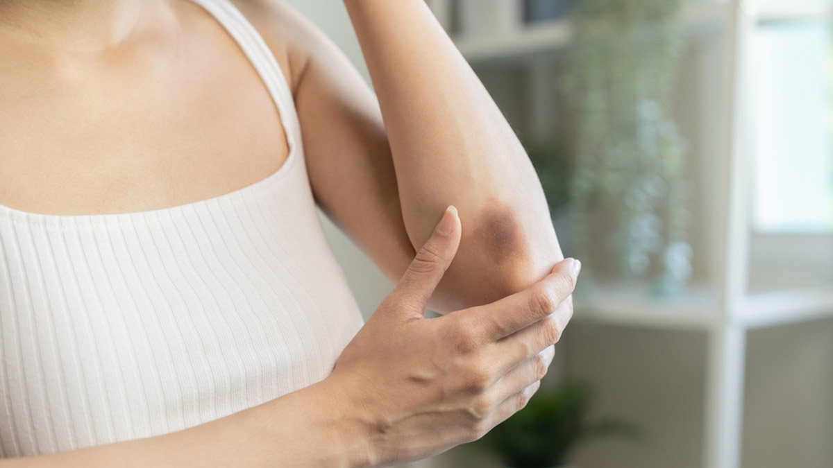 Haemophilia B: The Rare Disorder That Might Be Hiding Behind Your Bruises