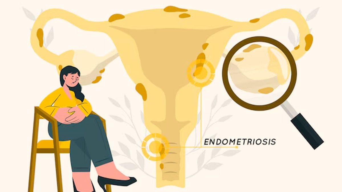 IVF And Endometriosis: How To Manage Symptoms And Improve Success Rate